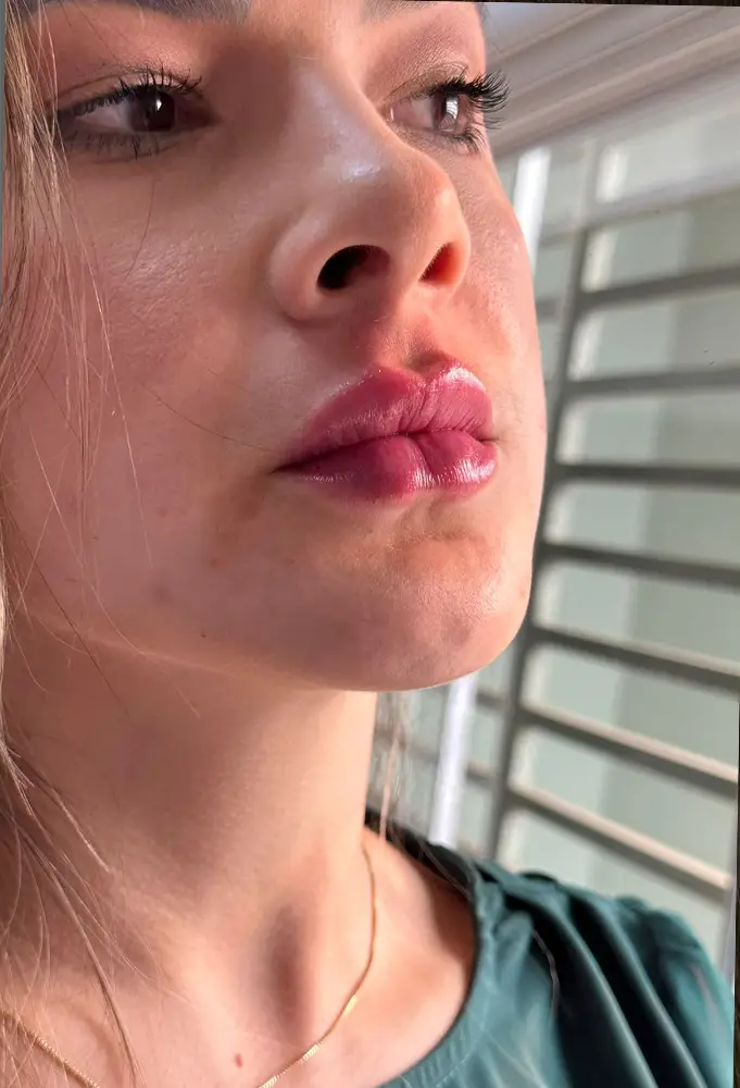 harmonizacao-porto-velho-ro-adyllacoimbra-faciais