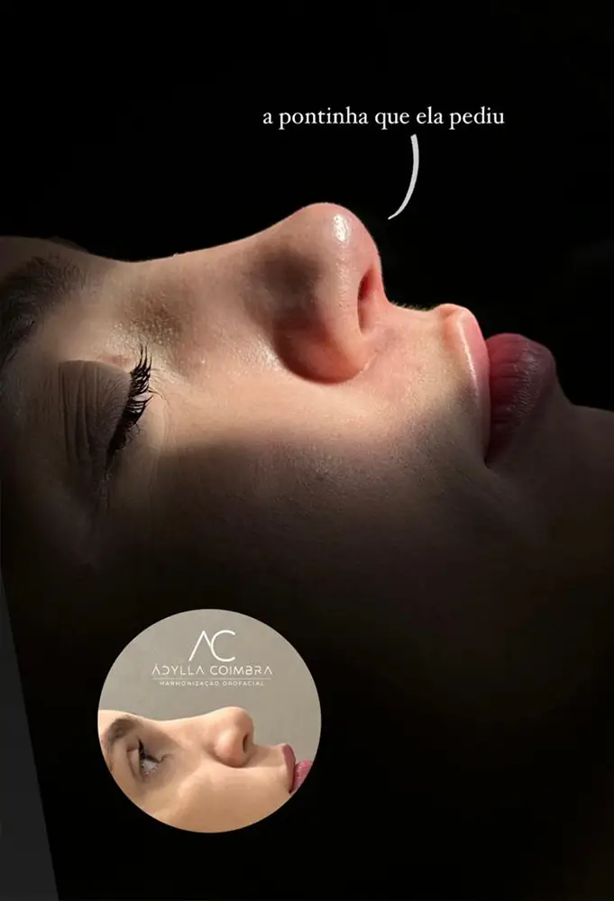 harmonizacao-porto-velho-ro-adyllacoimbra-nariz