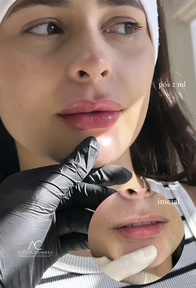 harmonizacao-porto-velho-labios-adylla-coimbra