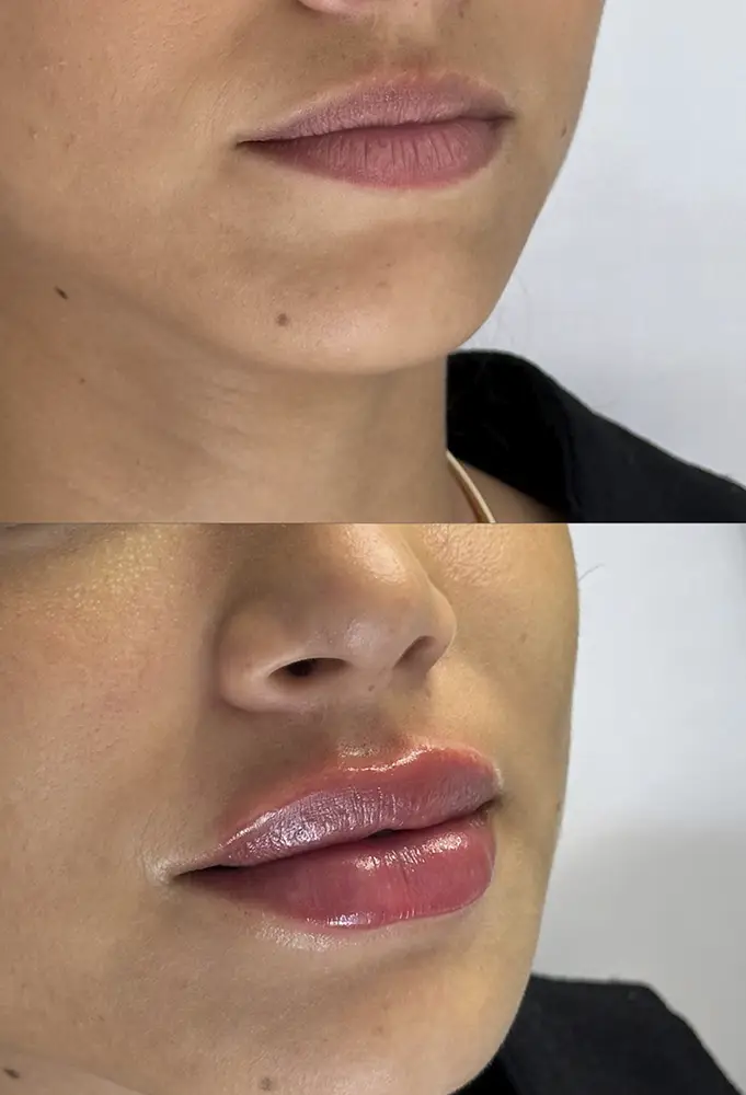 harmonizacao-porto-velho-ro-adylla-labios-3