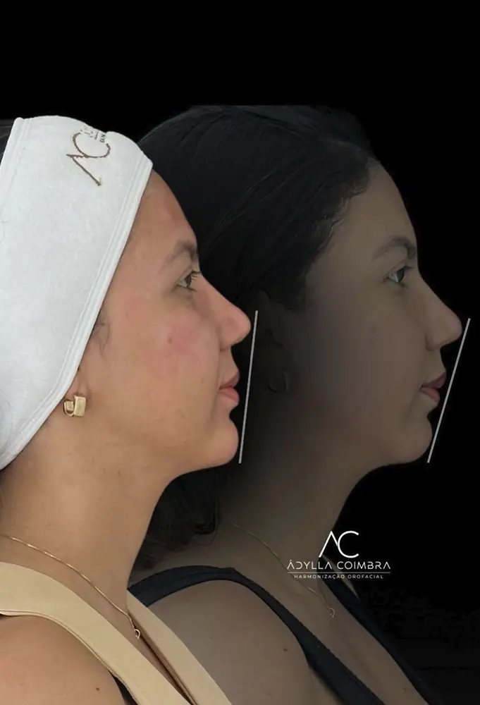 harmonizacao-porto-velho-ro-adylla-rosto